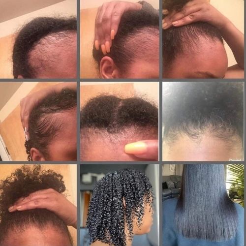 Understanding Alopecia: A Guide to Hair Loss, Treatment, and Hope